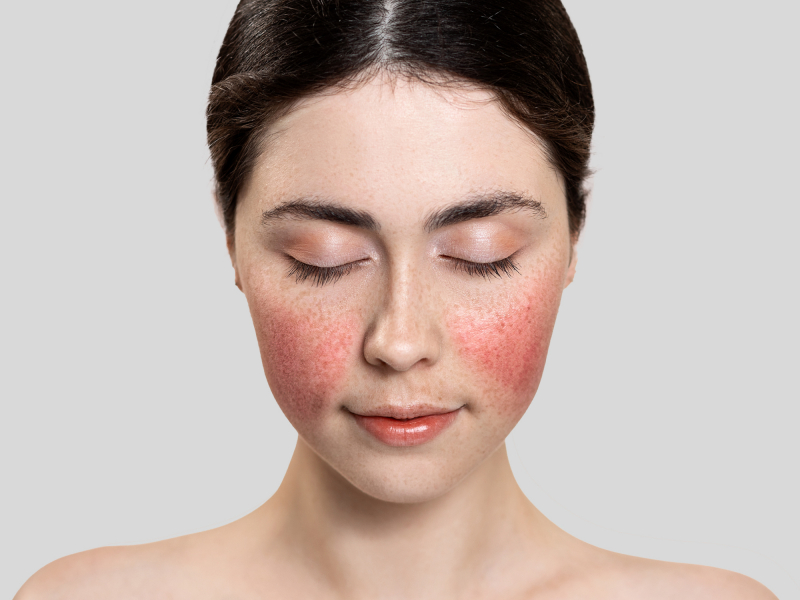 Woman with couperose on cheeks