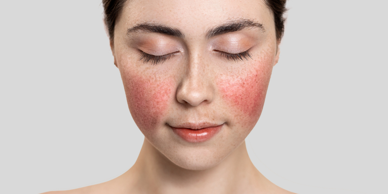 Woman with couperose on cheeks